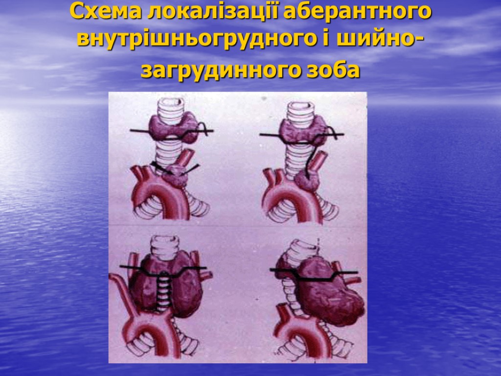 Схема локалізації аберантного внутрішньогрудного і шийно-загрудинного зоба